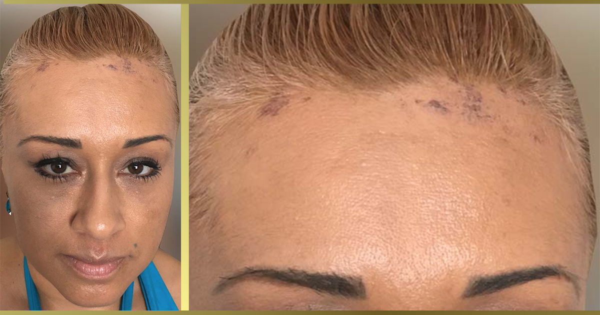 Chemical Burns From Hair Color | Cranial Prosthesis