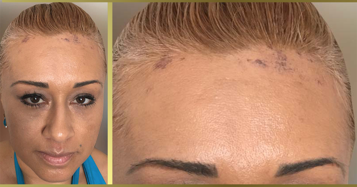 chemical burn from bleaching hair