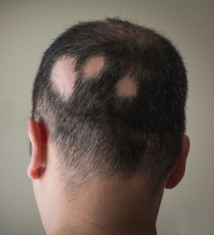 Alopecia Areata Symptoms