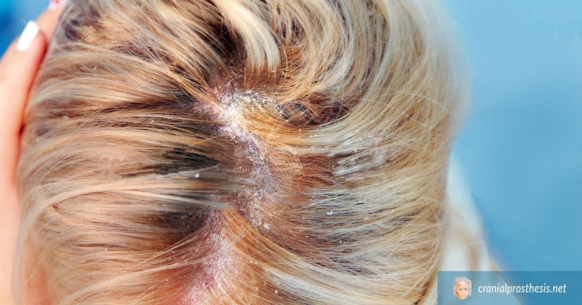 Exactly What Causes A Sensitive Scalp? | Cranial Prosthesis Wigs