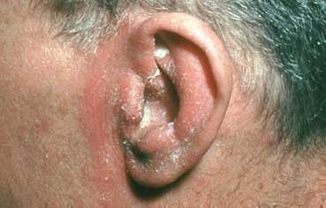 Seborrheic Dermatitis