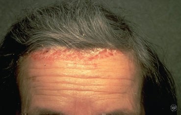 Scalp Psoriasis