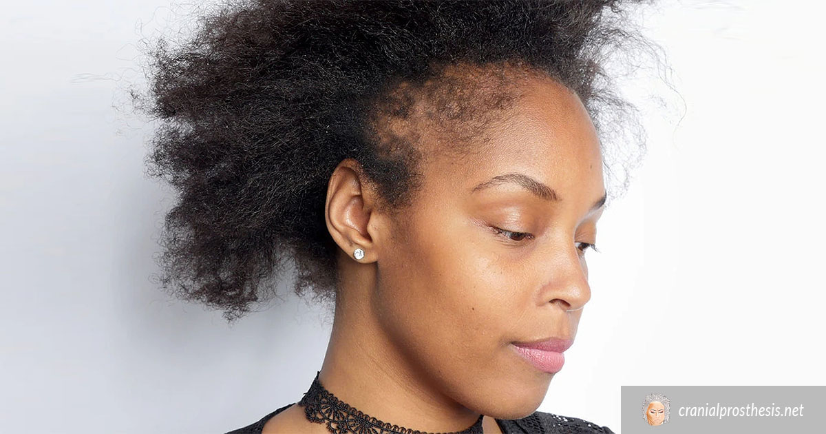 What You Should Know About Alopecia Areata