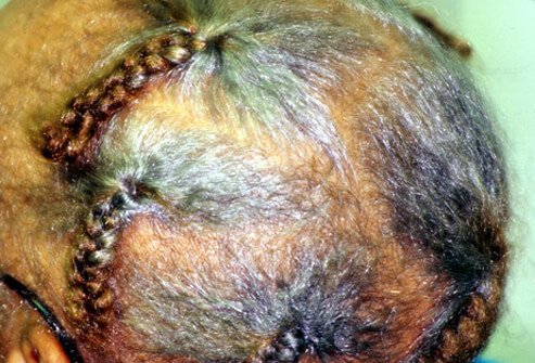 Traction Alopecia